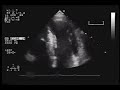 Heart UltraSound Comparison - Hypertrophic Cardiomyopathy