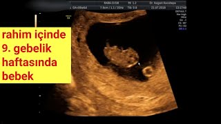 9. gebelik haftası (8+6.gün) anne karnında yaklaşık iki aylık bebek,açıklamalı ultrason görüntüleri