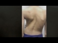 Birmingham Scoliosis Chiropractor - Dr. Mark Berry