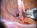 SILS Laparoscopic Appendectomy via Single Incision Surgery LESS / SPA/ Single Port Surgery