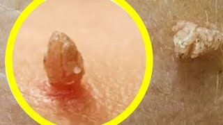 ПАПИЛЛОМЫ Моментально ВЫСОХНУТ И ОТПАДУТ САМИ, ЕСЛИ СМАЗАТЬ ИХ Домашним НЕ Дорогим СРЕДСТВОМ...
