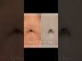 Belly Button Reconstruction with Tummy Tucks