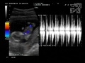 Bumps 13 Week Ultrasound!