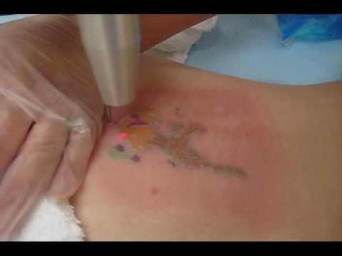 Tags:tattoo removal pain tattoo removal cost tattoo removal pricing how to 