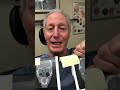 In Office Balloon Sinus Dilation 3 years ago-doing well
