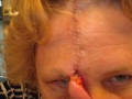 Mohs Surgery and Forehead Flap Nose Reconstruction