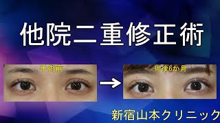 腫れない切開手術はありません!! 新宿 山本クリニック
