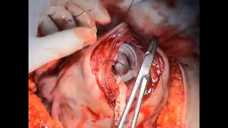 Sezeryan histerektomi bilateral hipogastrik arter ligasyonu/Cesarean hysterectom