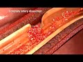 HEART ATTACK (ACS & MI)