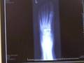 Navicular Bone Human Anatomy | RM. Navicular Bone Human Anatomy | RM.