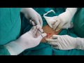 Pfannenstiel Incision - For Ovarian Cyst and Appendicectomy