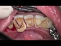 Limpieza de Sarro Dental - Clinica Dental Krebs - Peru