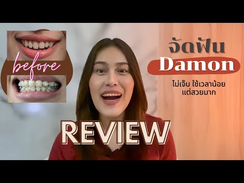 REVIEW จัดฟัน Damon 😬 เจ็บน้อย แต่สวยมากแม่ | ราคาเท่าไหร่ ผลเป็นยังไง??