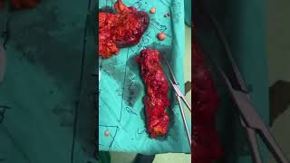 İleri evre yumurtalık kanserinde sitoredüktif ameliyat (Splenektomi, Kolon rezek