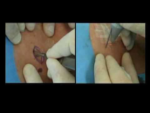 excision tattoo removal cost pics of tattoos behind the ear