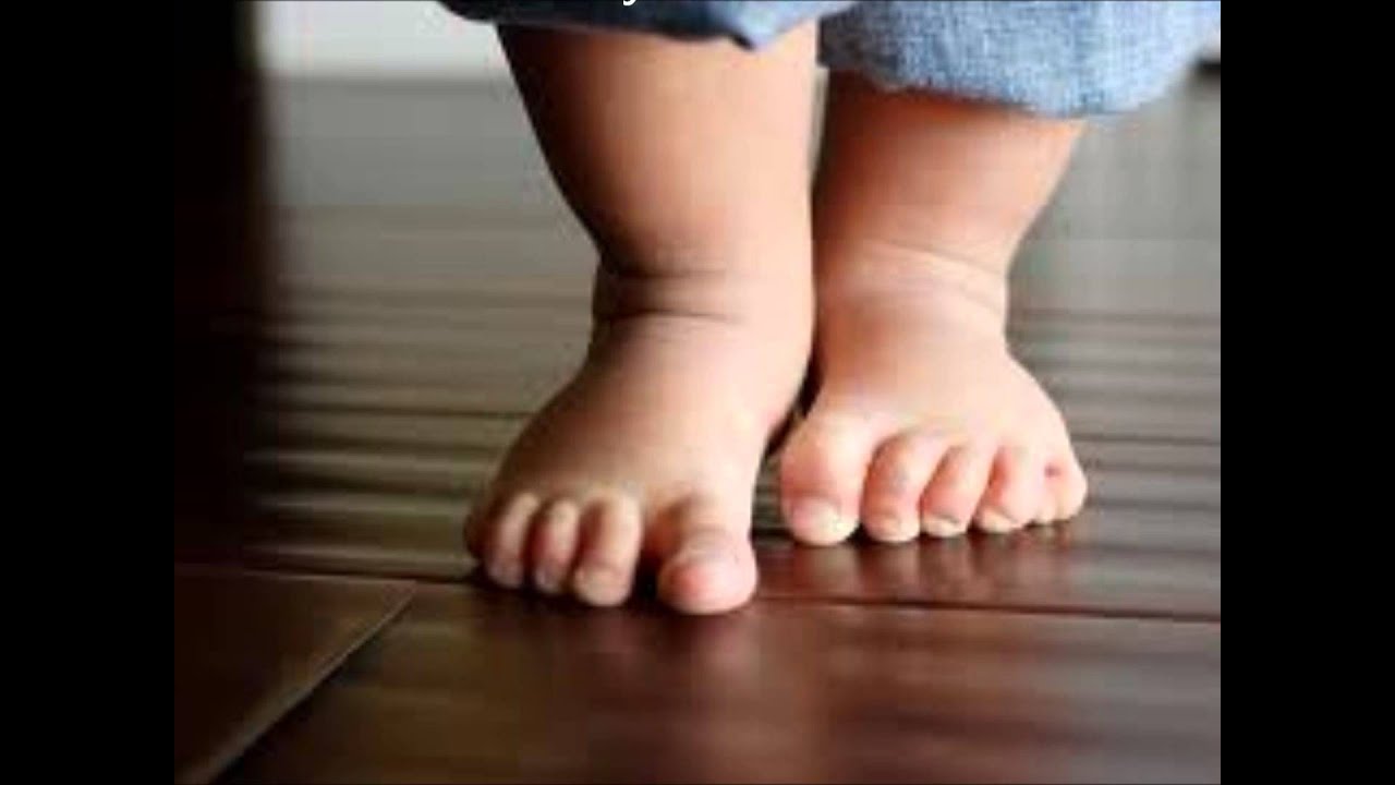 Варус стопы у детей фото Варус стопы у детей фото