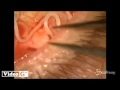 L'estrazione di un verme di 12 cm dall'occhio