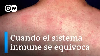 La Alergia Un Error Del Sistema De Defensa Del Organismo