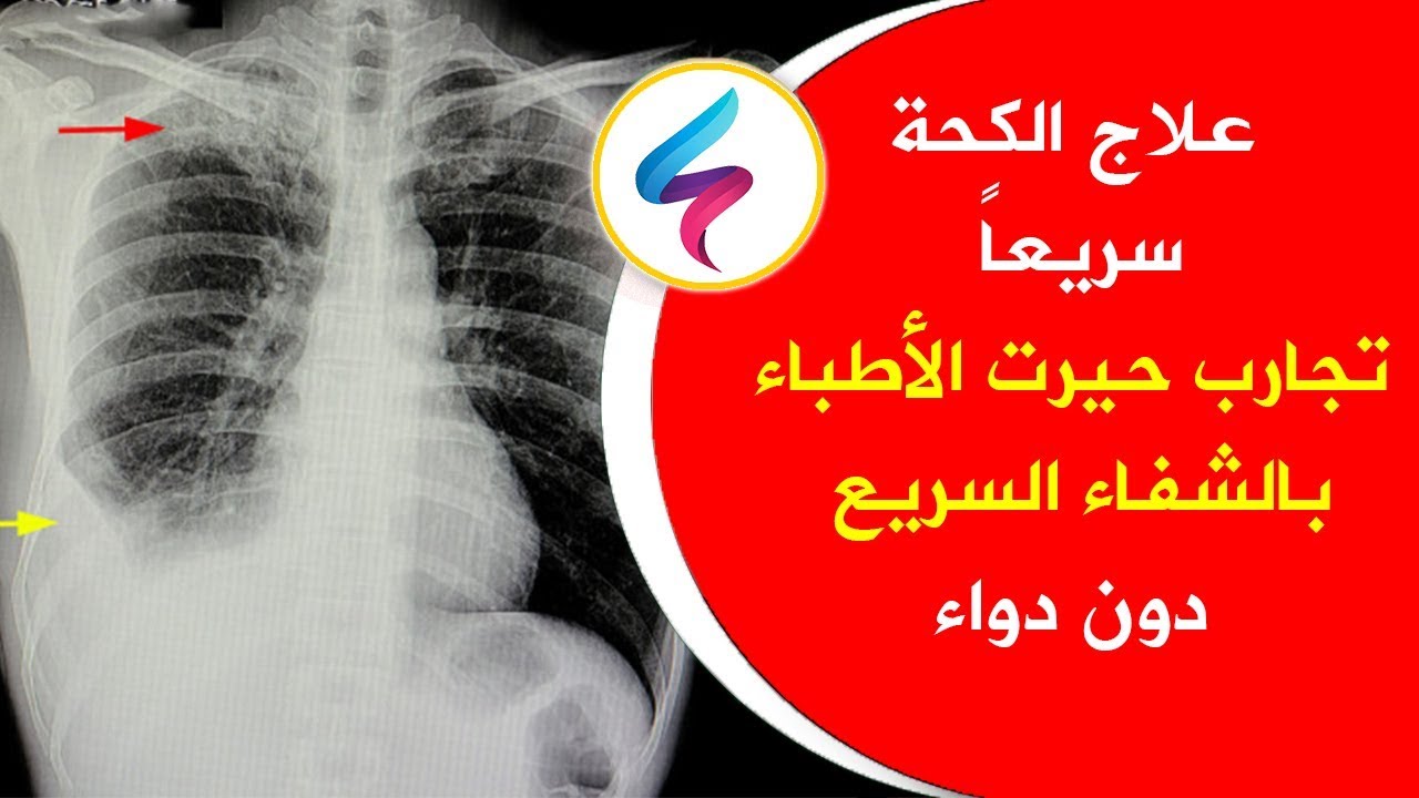 ما هي أفضل طرق علاج الكحة على اختلاف أنواعها؟