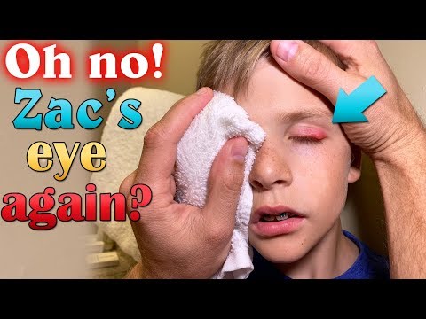 What Happened to His Eye??!!