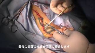 刺青切除(腰)13センチ 山本クリニック