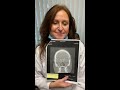 Endoscopic Sinus Surgery&Septoplasty 1 Year ago and doing very well