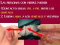 Herpes Genital