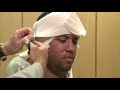 Otoplasty post-operative consultation by John E. Sherman, MD, FACS New York plastic surgeon