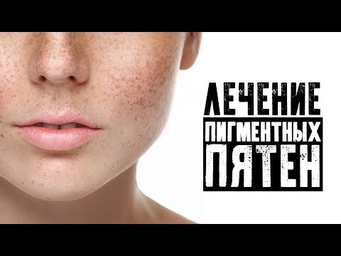 Лечение пигментных пятен Лечение пигментных пятен