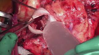 Redo AVR for Paravalvular Leak Following TAVR
