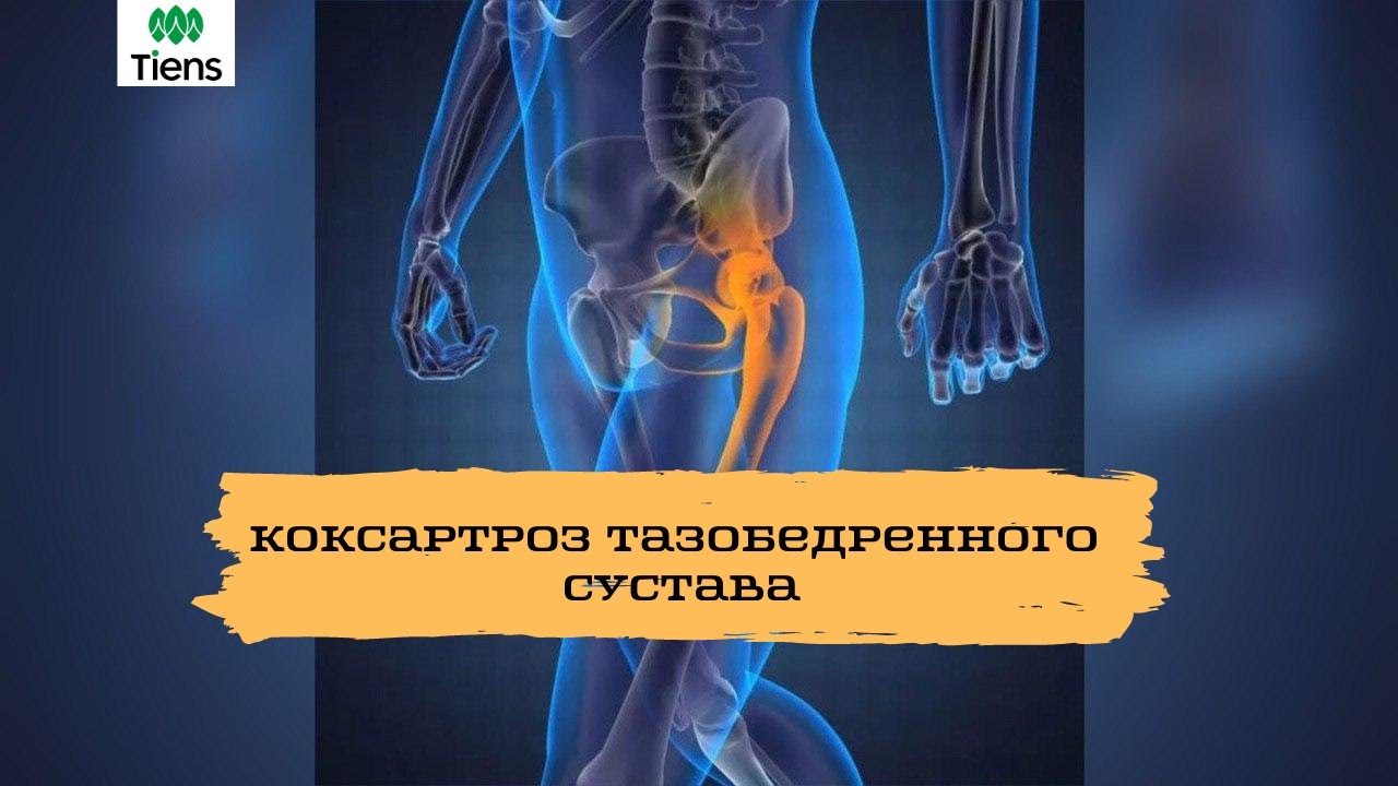 Диета При Коксартрозе Тазобедренного Сустава 3