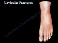 Navicular Fractures - Everything You Need To Know - Dr. Nabil Ebraheim