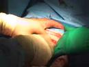 Colon Surgery
