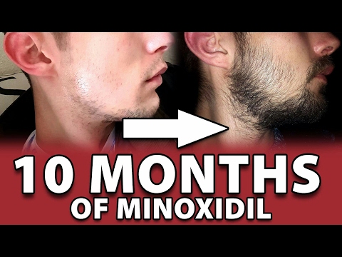 Beard rogaine spots for bald Minoxidil Beard