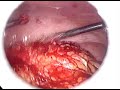 Peritonitis Apendicular - Centro Laparoscópico Dr. Ballesta