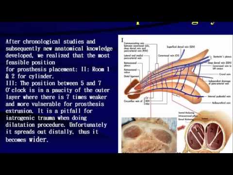penile prothesis surgery penile prothesis surgery