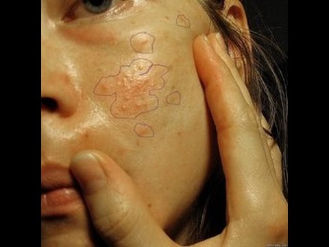 Как лечить подкожного клеща на лице в домашних условиях Как лечить подкожного клеща на лице в домашних условиях