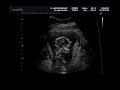 eco 15 semanas. mathias david