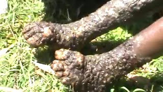 Andrew's Jigger Treatment, Part One Parasitic Fleas Removed in Remote Kenya Andrew's Jigger Treatment, Part One Parasitic Fleas Removed in Remote Kenya