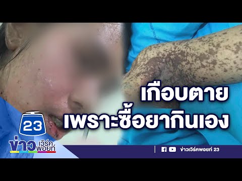 สาวปวดฟันคุด ทนไม่ไหวซื้อยากินเอง แต่แพ้หนักเข้า ICU l บรรจงชงข่าว l 4 มิ.ย. 63