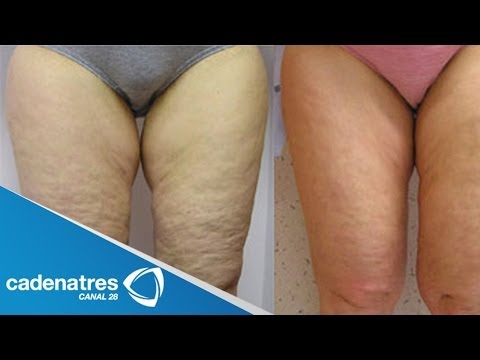 Мезотерапия целлюлит в домашних условиях 641