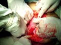 multiple fibroid uterus