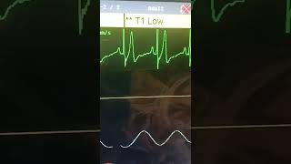 Clinical Findings May Tall T Waves Indicate ?? Suggest Hyperkalemia Or Mi.