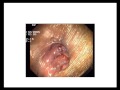 Pictures of Hemorrhoids Hemroid Harrys Herbal Remedy default Pictures of Hemorrhoids Hemroid Harrys Herbal Remedy