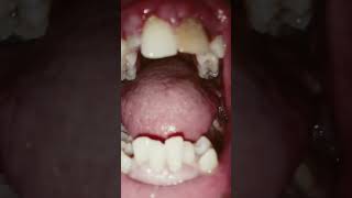 Gum Vore