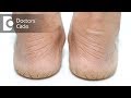 What causes cracks on heels & its management? - Dr. Nischal K