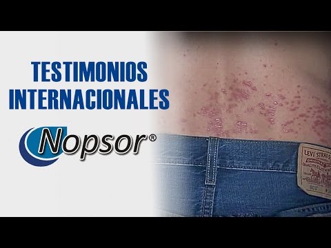 Como comprender que pasa la psoriasis
