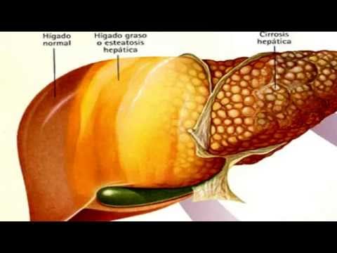 Las enfermedades vasculares y el alcoholismo