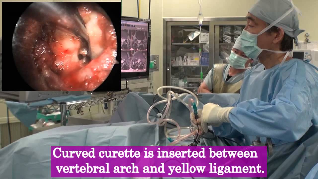 Operative procedure of Micro Endoscopic Discectomy (MED) for L5/S1