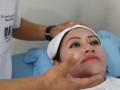 Peeling químico, eliminar arrugas, quitar manchas en la cara - Dermatologo en Lima Perú